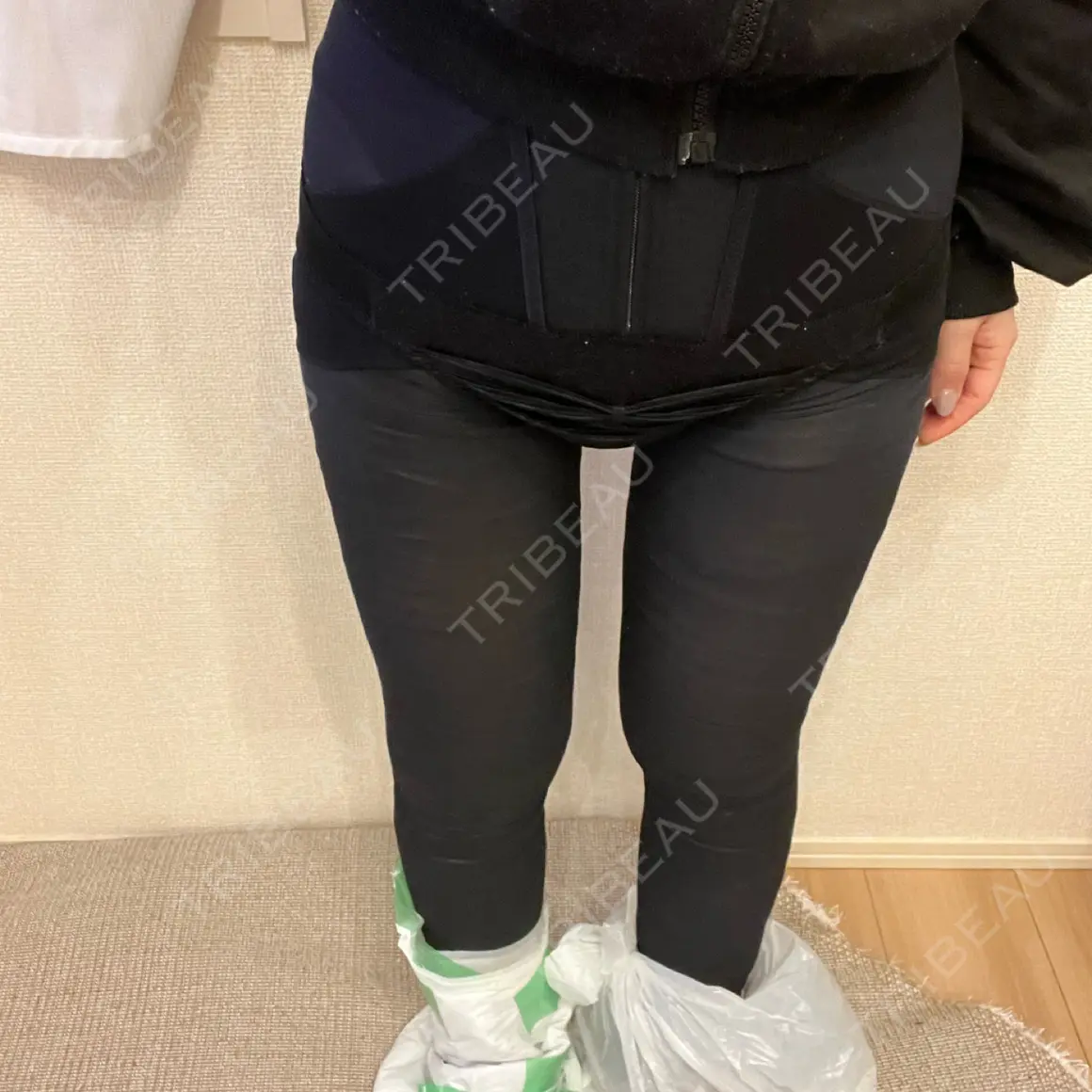 脂肪吸引（脚） 湘南美容クリニック 京都院 DAY 1