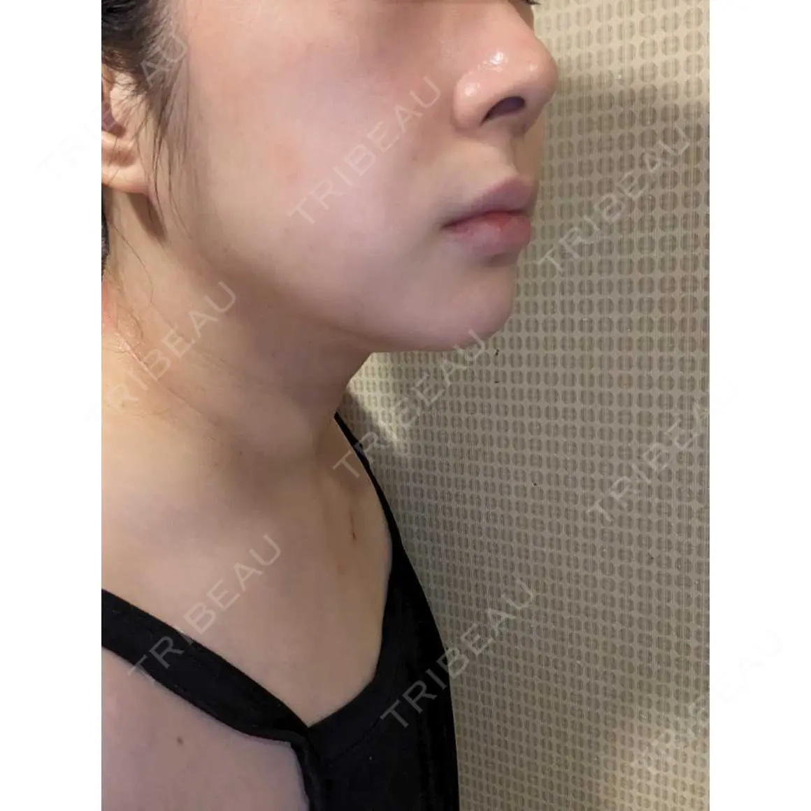 エレクトロポレーション / ルメッカ B-LINE CLINIC 池袋院 DAY 4