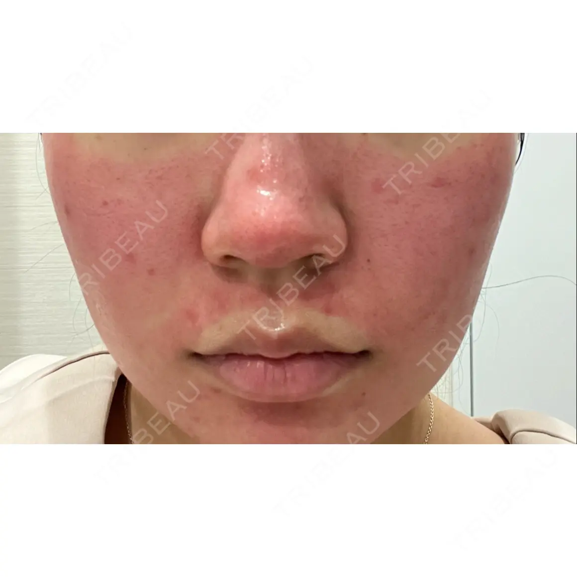ダーマペン / 毛穴洗浄（ハイドラフェイシャルなど） B-LINE CLINIC 池袋院 DAY 0