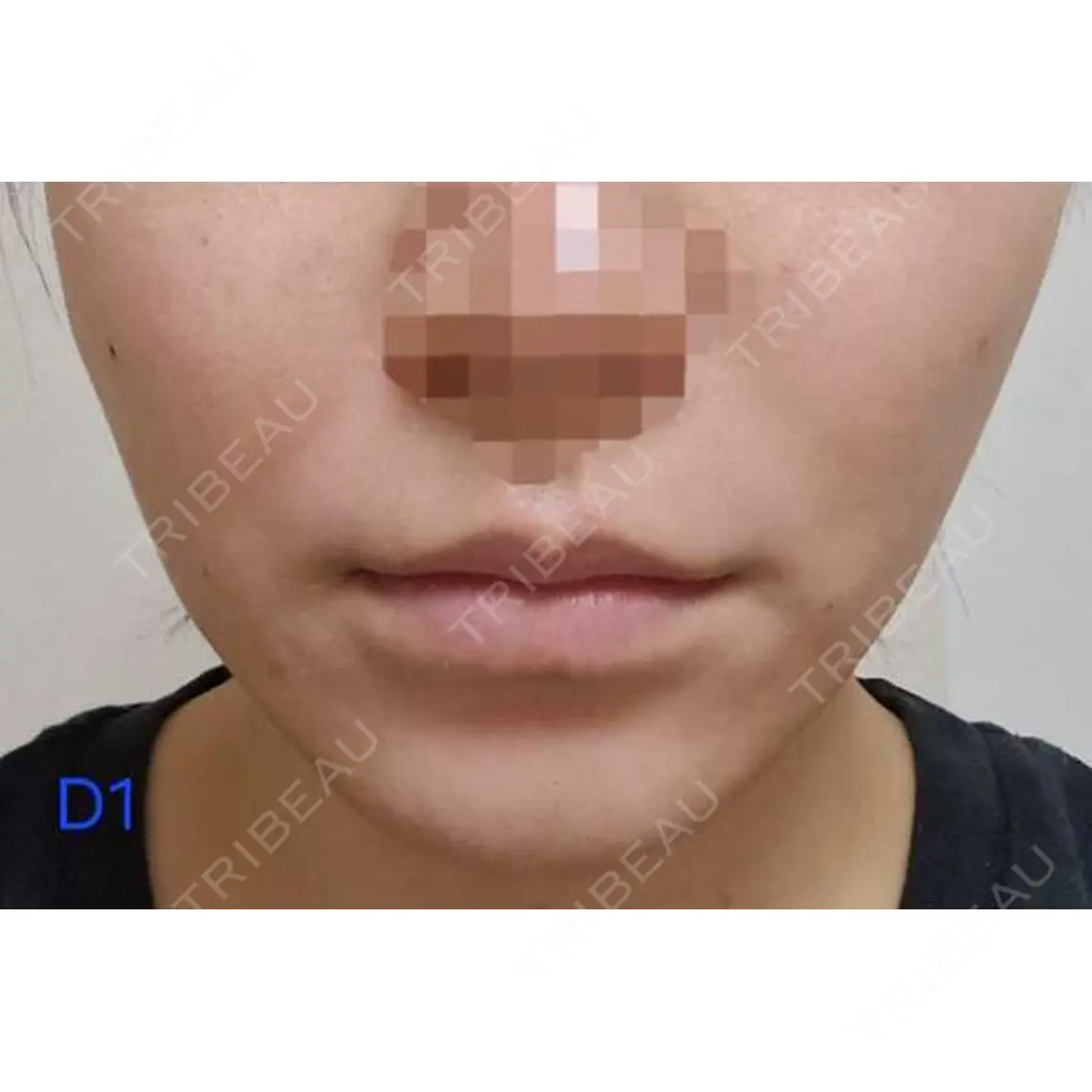 脂肪注入（肌） / ボトックス（口角） LIBER CLINIC AFTER