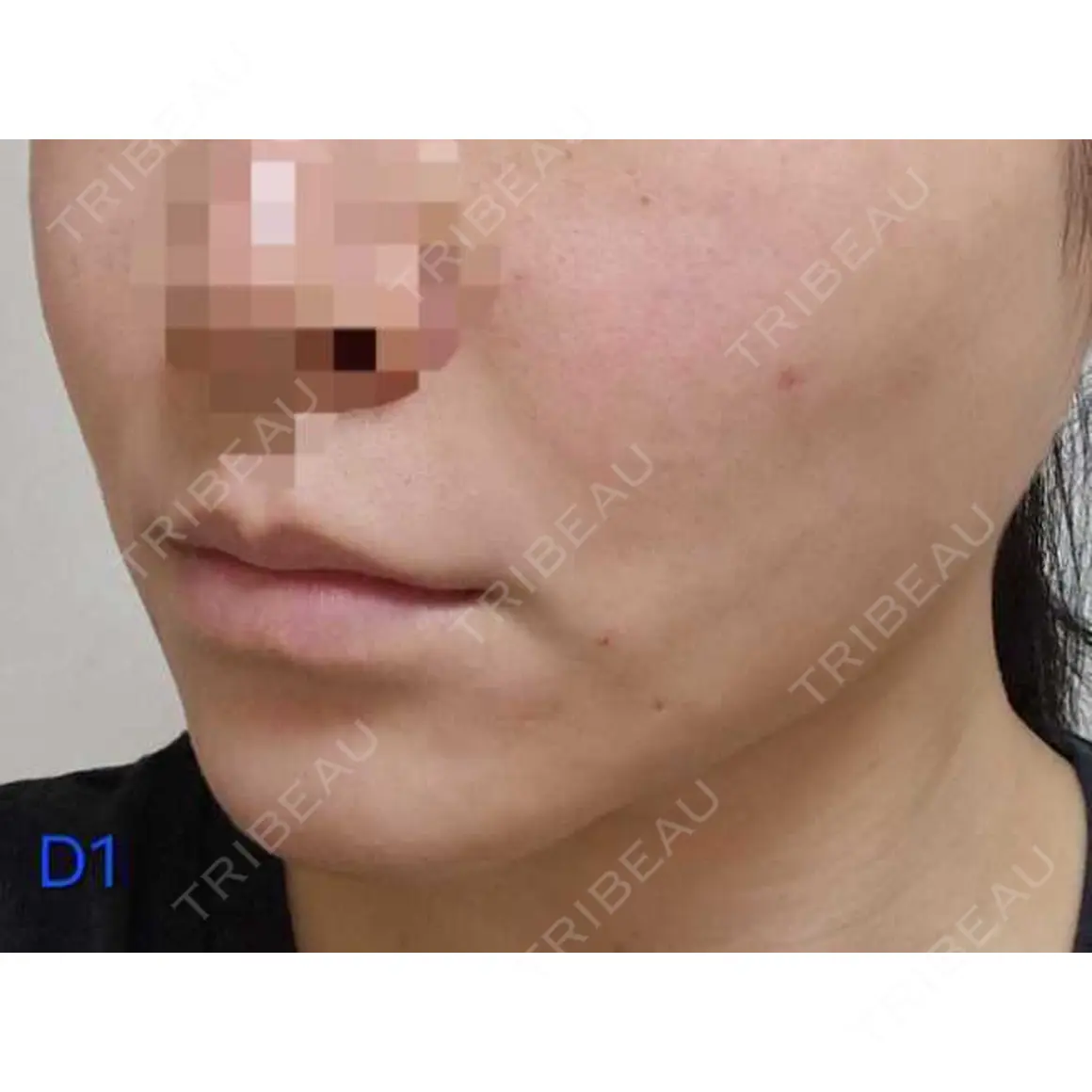 脂肪注入（肌） / ボトックス（口角） LIBER CLINIC AFTER
