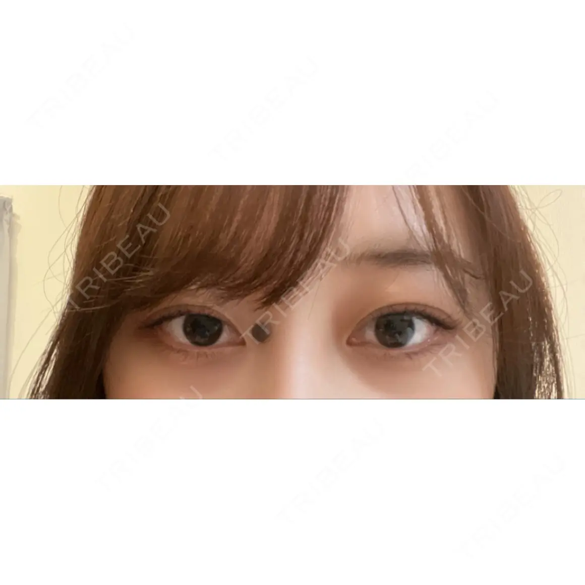 二重埋没 LUHO（ルホ）美容外科 AFTER