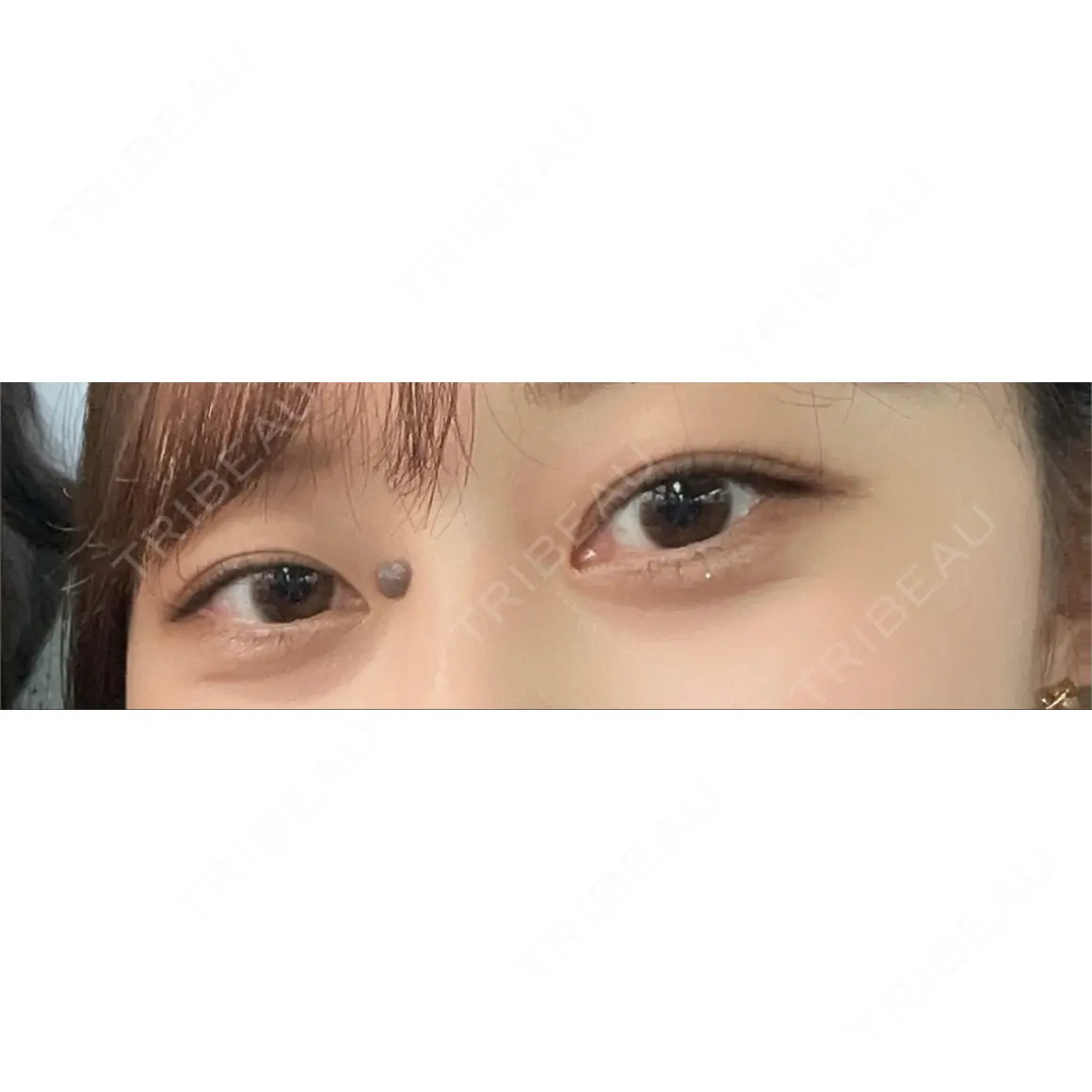 二重埋没 LUHO（ルホ）美容外科 AFTER