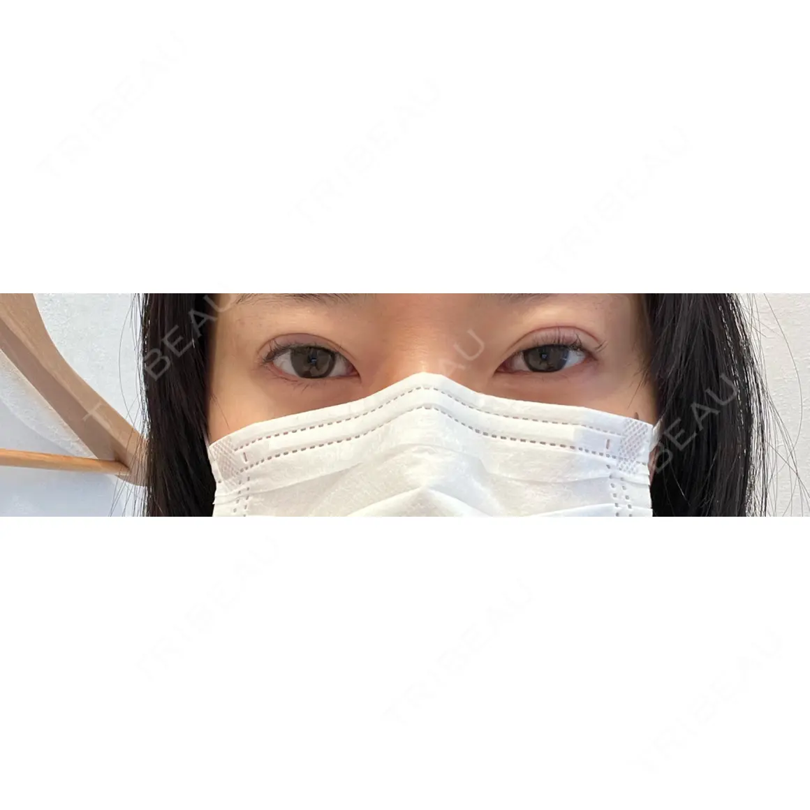 二重埋没 お茶の水美容形成クリニック DAY 0