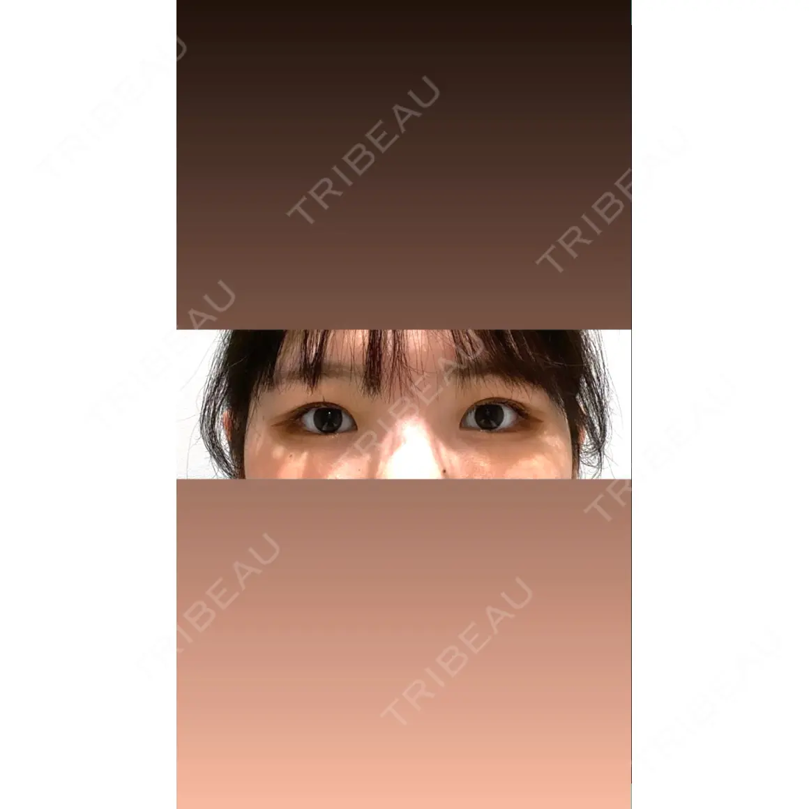 二重埋没 / 上まぶたの脂肪取り / その他（目元） 9BeautyClinic AFTER