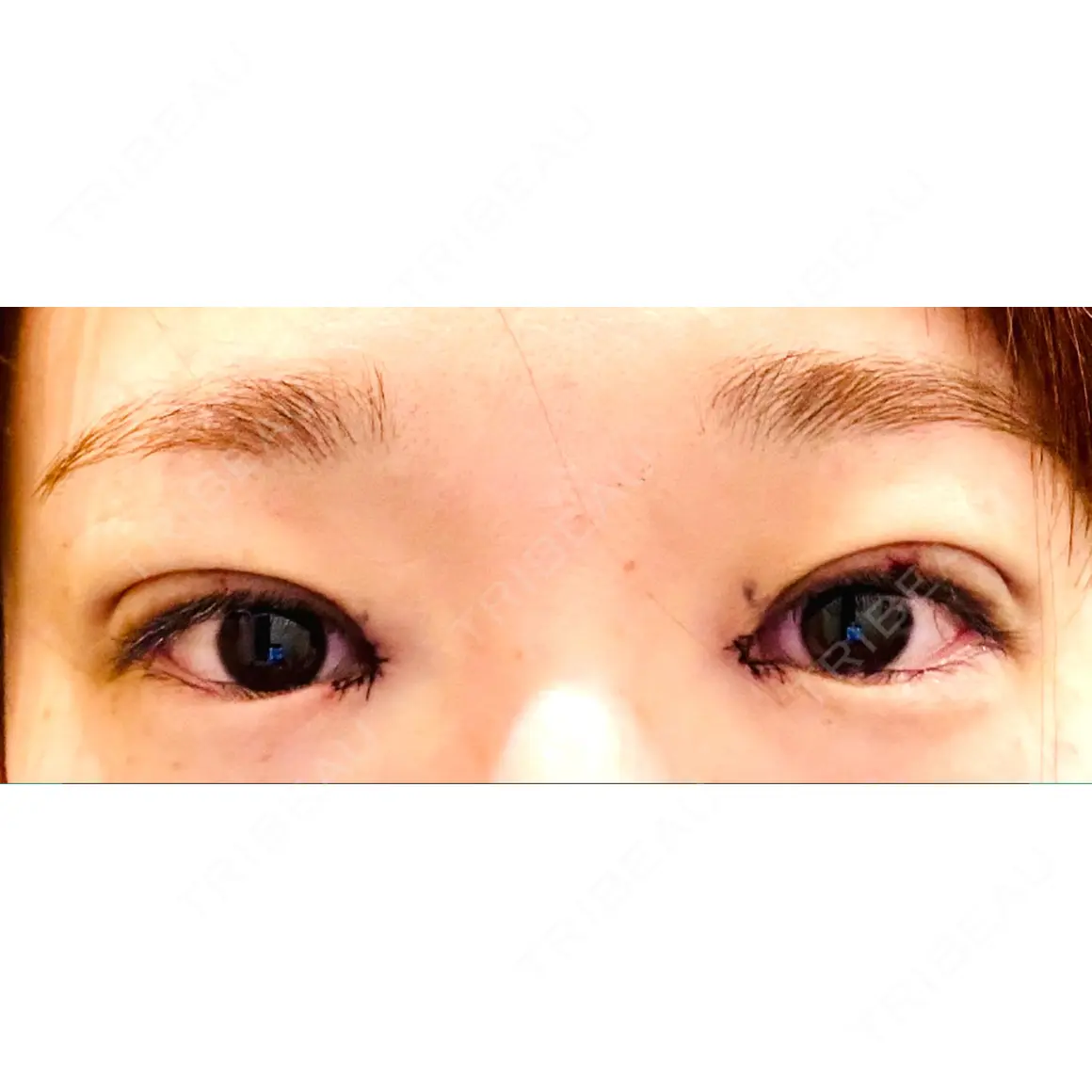 目頭切開 / 自然癒着法 / 眼瞼下垂（非切開） LUHO（ルホ）美容外科 DAY 0