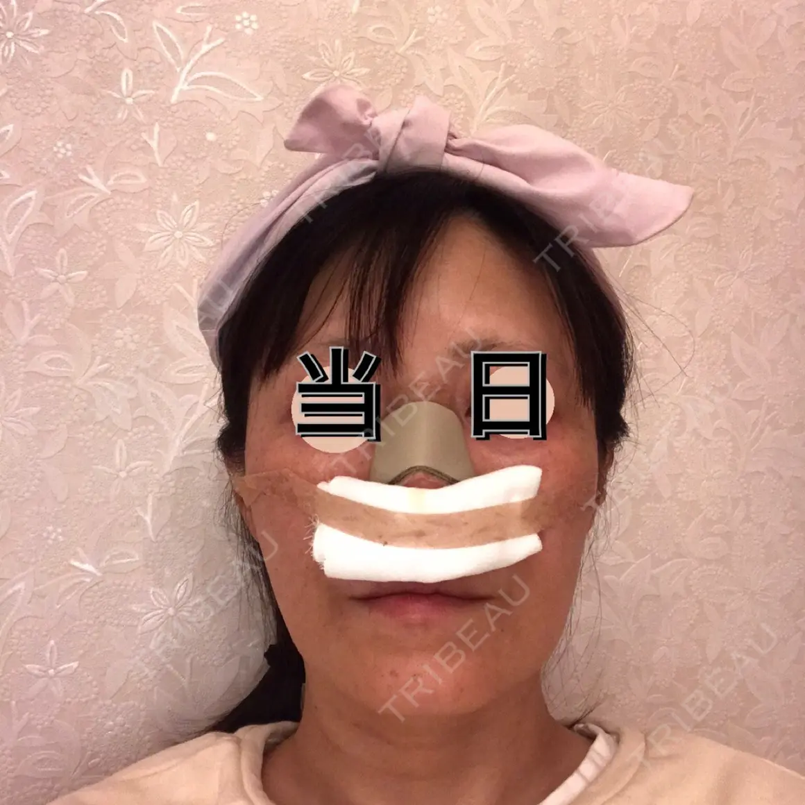 鼻尖形成（切開） / 鼻中隔延長（切開） / 軟骨移植 WOM CLINIC GINZA （ワム クリニック ギンザ） DAY 0