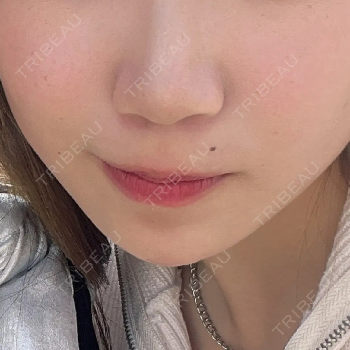ヒアルロン酸注入（あご） / ボトックス（エラ・小顔） ルラ美容クリニック 町田院 AFTER