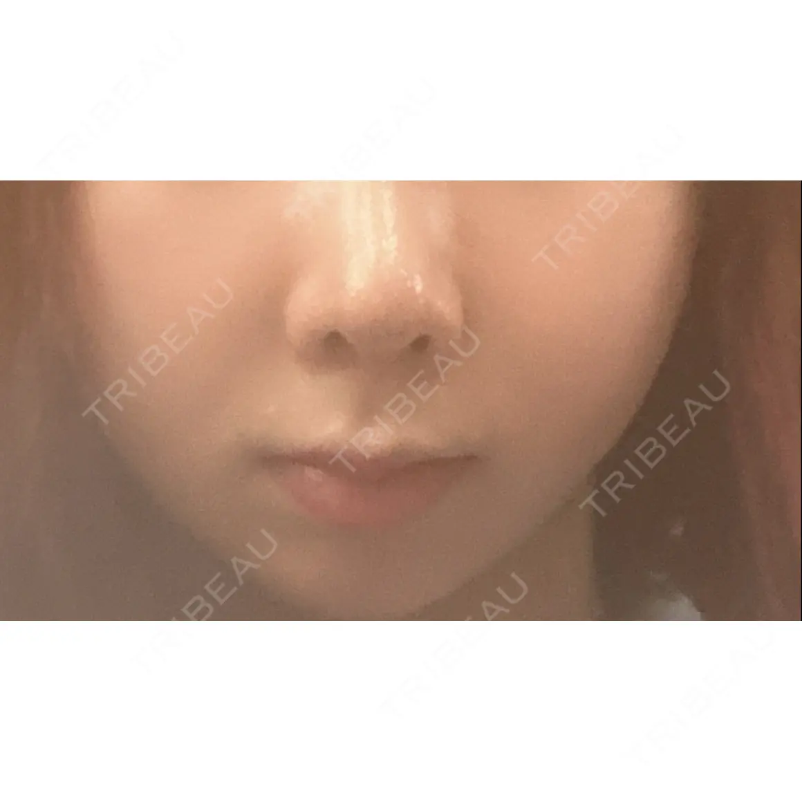 鼻尖形成（切開） / 軟骨移植 / 骨切幅寄せ 9BeautyClinic AFTER