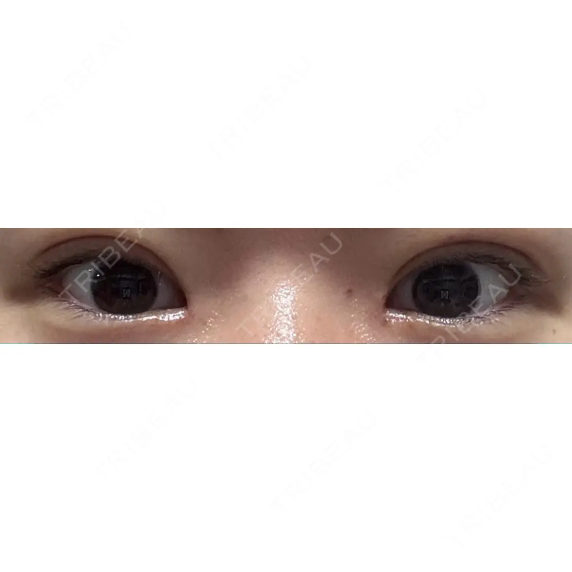 二重埋没 / 目頭切開 / 上まぶたの脂肪取り LUHO（ルホ）美容外科 DAY 28
