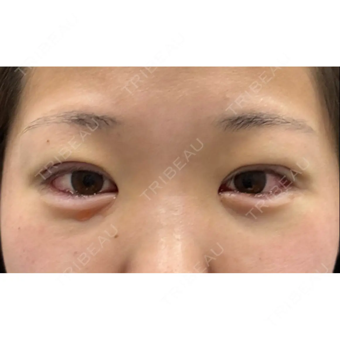 二重埋没 / クマ治療 / 上まぶたの脂肪取り 9BeautyClinic DAY 0