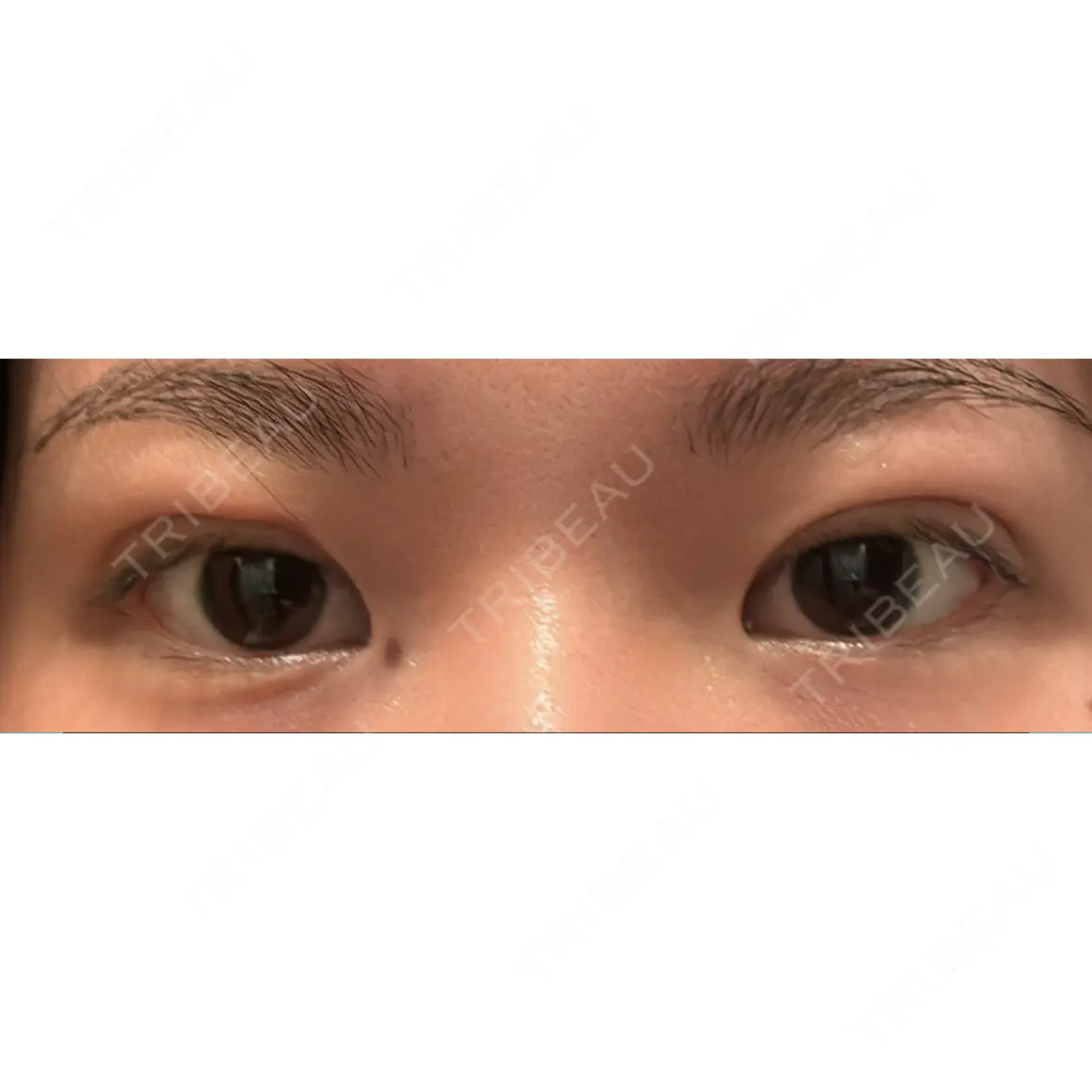 二重埋没 / 上まぶたの脂肪取り 9BeautyClinic AFTER