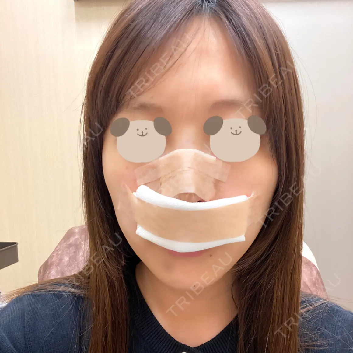 鼻中隔延長（切開） / 軟骨移植 / 鼻翼基部形成（貴族手術） / 鼻柱下降・鼻唇角形成（猫手術） La Clinique Shinjuku 【ラクリニック 新宿】 DAY 0