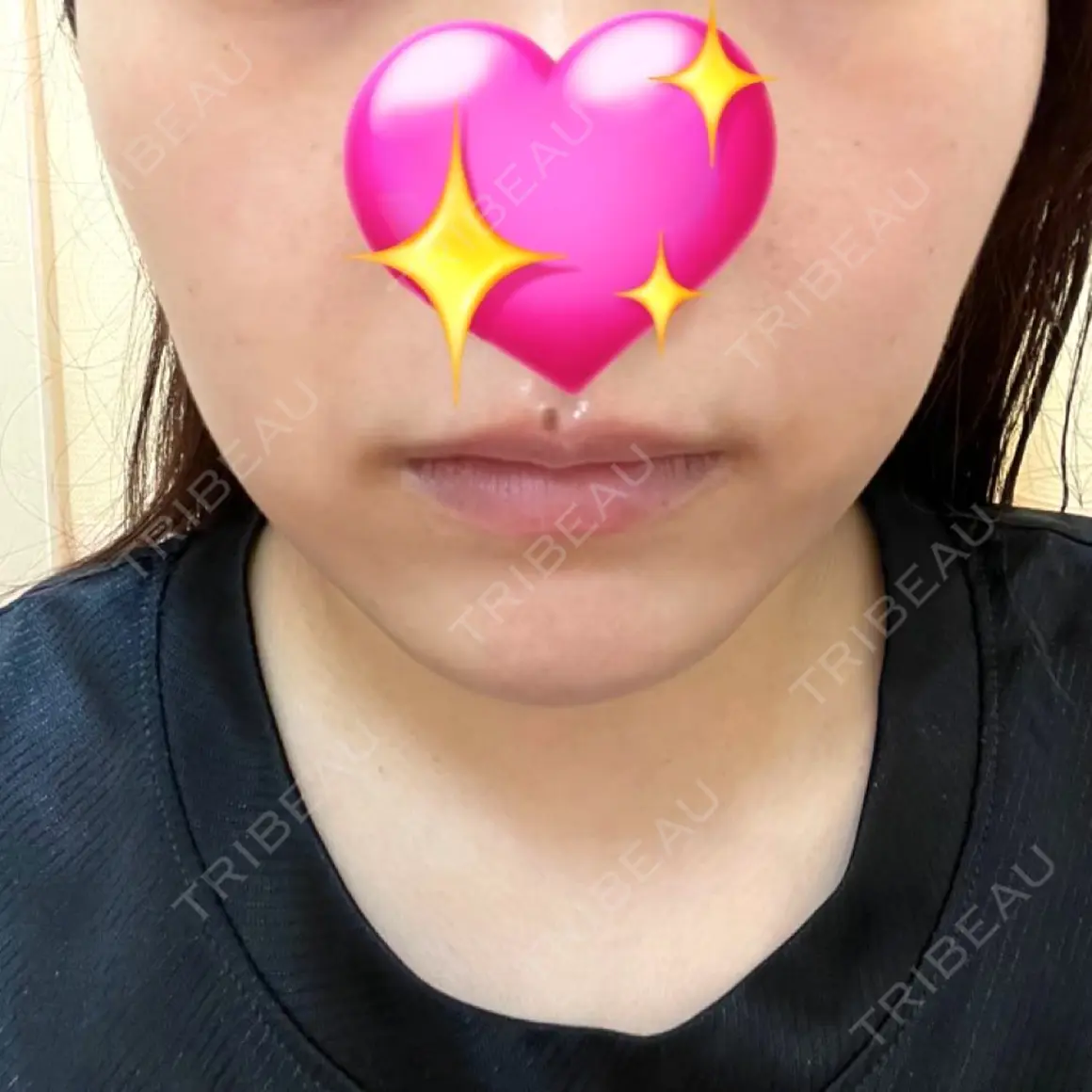 ピーリング（ニキビ・毛穴） / イオン導入 渋谷美容外科クリニック 池袋院 DAY 0