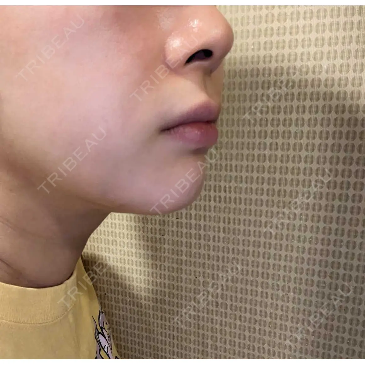 エレクトロポレーション / ルメッカ B-LINE CLINIC 池袋院 AFTER