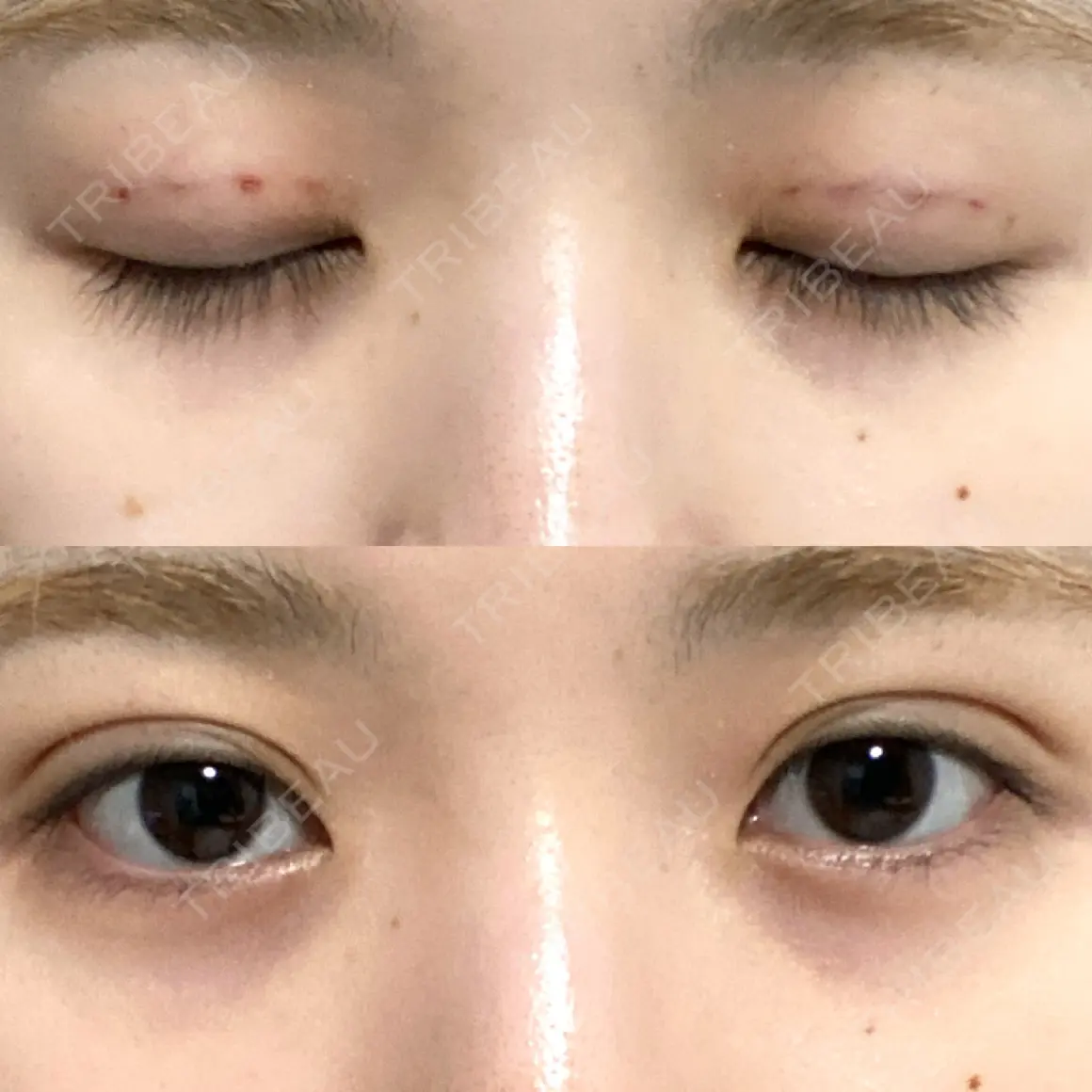 二重埋没 / 自然癒着法 Brandnew Beauty Clinic DAY 0