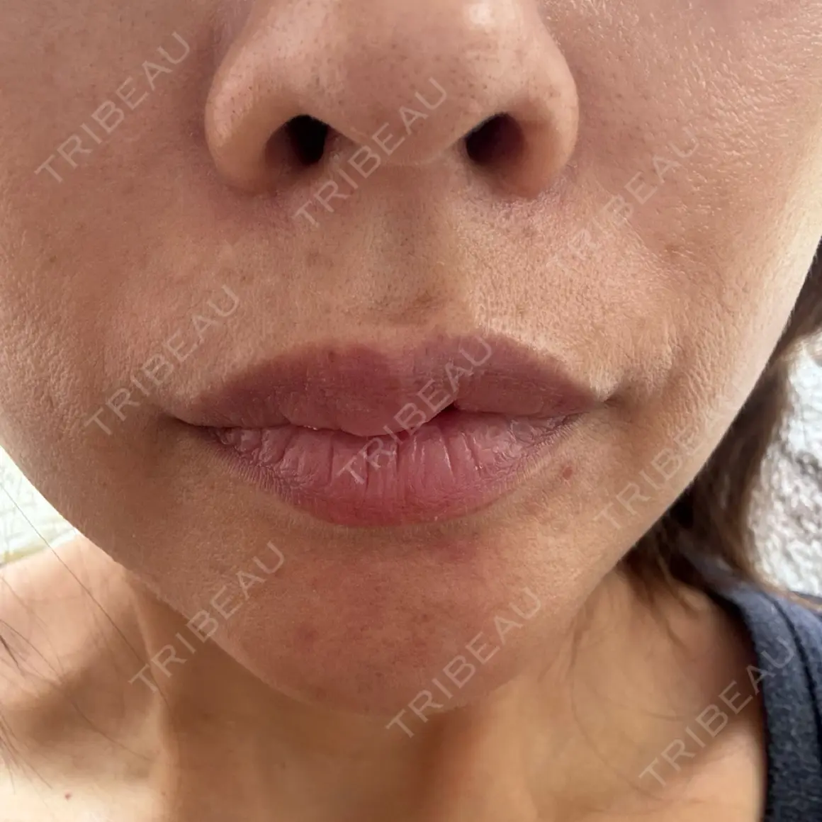 ヒアルロン酸注入（唇） / ボトックス（口角） / ボトックス（人中） / その他（口元） Otus Clinic 【オータスクリニック】 AFTER