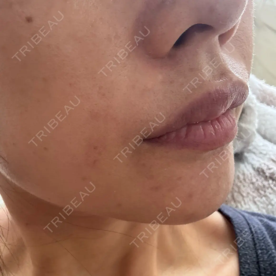 ヒアルロン酸注入（唇） / ボトックス（口角） / ボトックス（人中） / その他（口元） Otus Clinic 【オータスクリニック】 AFTER