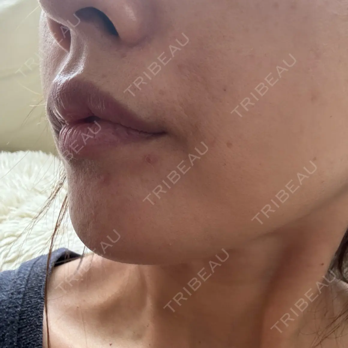 ヒアルロン酸注入（唇） / ボトックス（口角） / ボトックス（人中） / その他（口元） Otus Clinic 【オータスクリニック】 AFTER