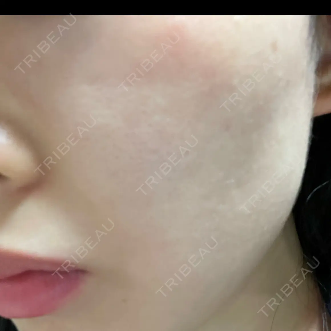 エレクトロポレーション Kinshicho Beauty Clinic （錦糸町ビューティークリニック） AFTER
