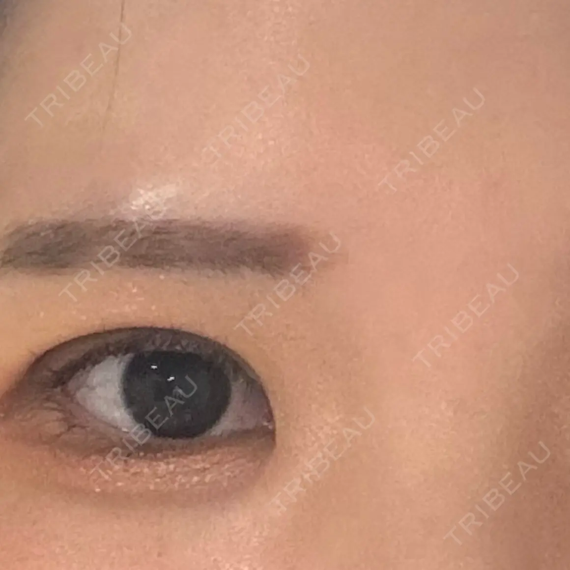 二重埋没 お茶の水美容形成クリニック AFTER