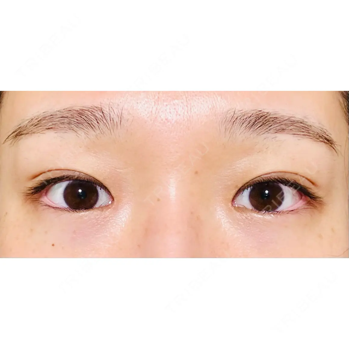 目頭切開 / 自然癒着法 / 眼瞼下垂（非切開） LUHO（ルホ）美容外科 AFTER
