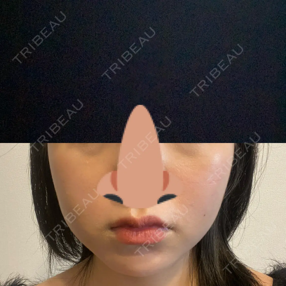 ボトックス（エラ・小顔） 共立美容外科 新宿本院 AFTER