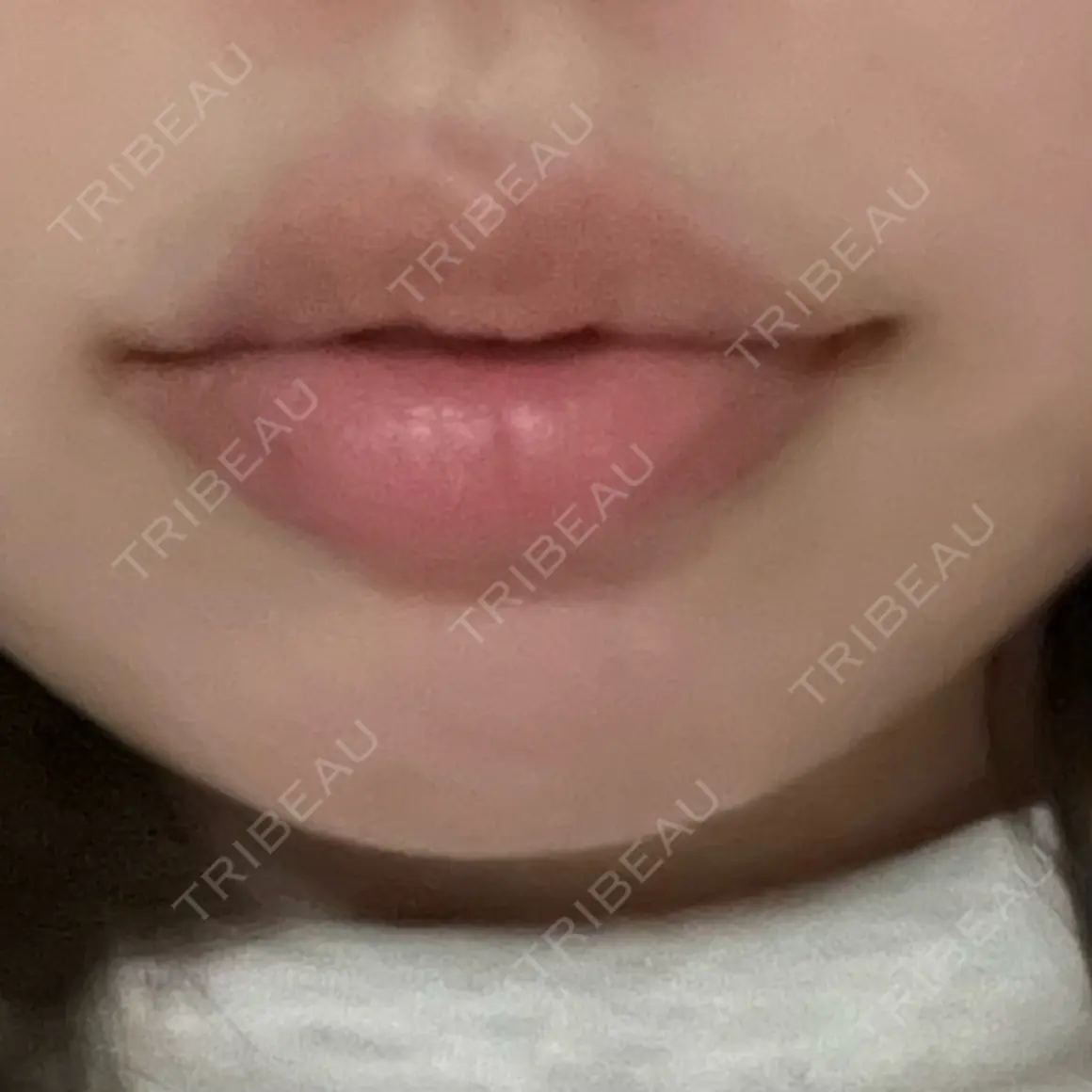 ヒアルロン酸注入（唇） DMTC CLINIC 日本橋院 AFTER