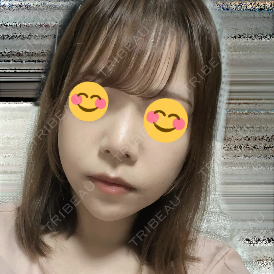 鼻尖形成（切開） / 軟骨移植 / ヒアルロン酸注入（鼻） / ヒアルロン酸注入（あご） ASTRA BEAUTY CLINIC AFTER