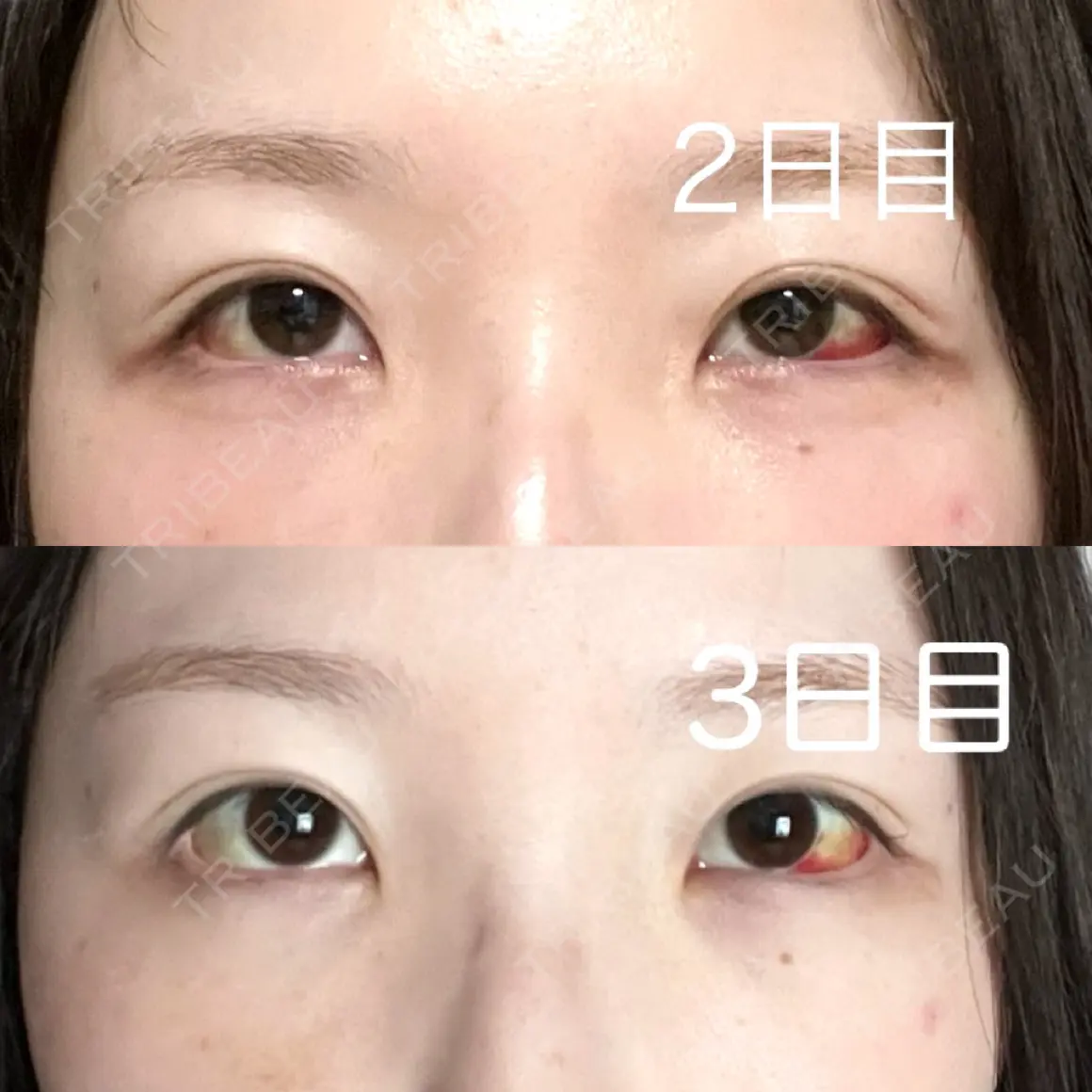 クマ治療 / ピコレーザートーニング（美白・肝斑） Days Beauty Clinic DAY 2