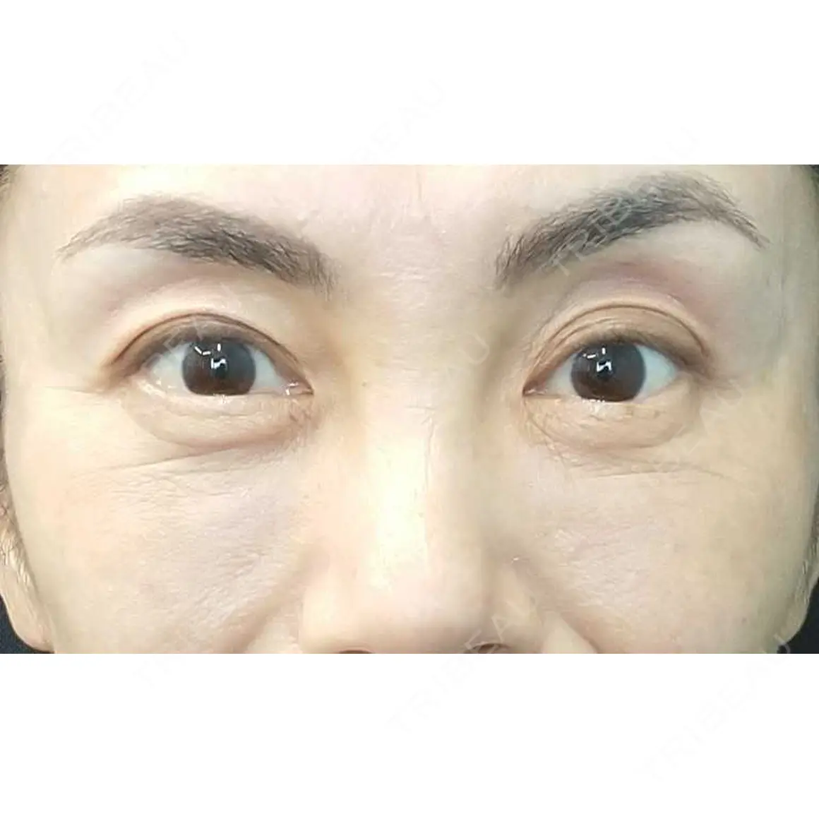 下まぶたの脂肪取り / 脂肪注入（目の下） 湘南美容クリニック 千葉センシティ院 AFTER