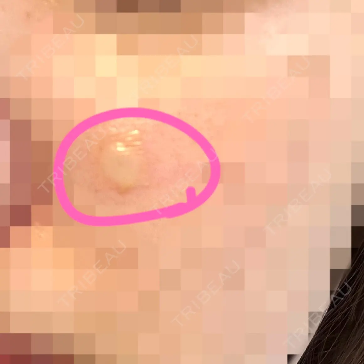 ほくろ・いぼ切除（肌） Jスキンクリニック 【J-SKIN clinic】 DAY 1