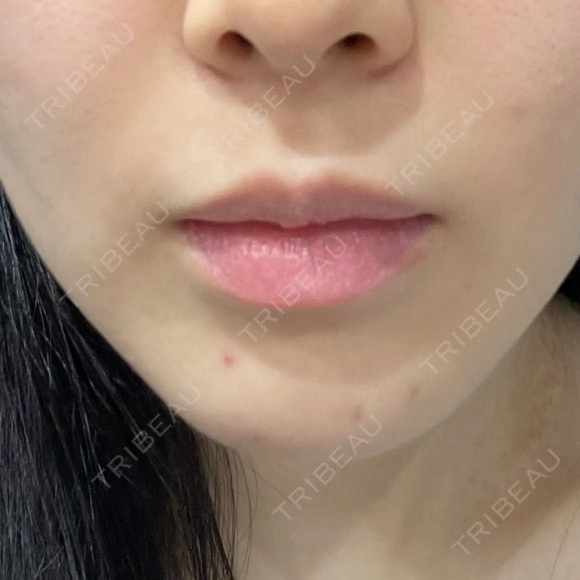 エレクトロポレーション Kinshicho Beauty Clinic （錦糸町ビューティークリニック） AFTER