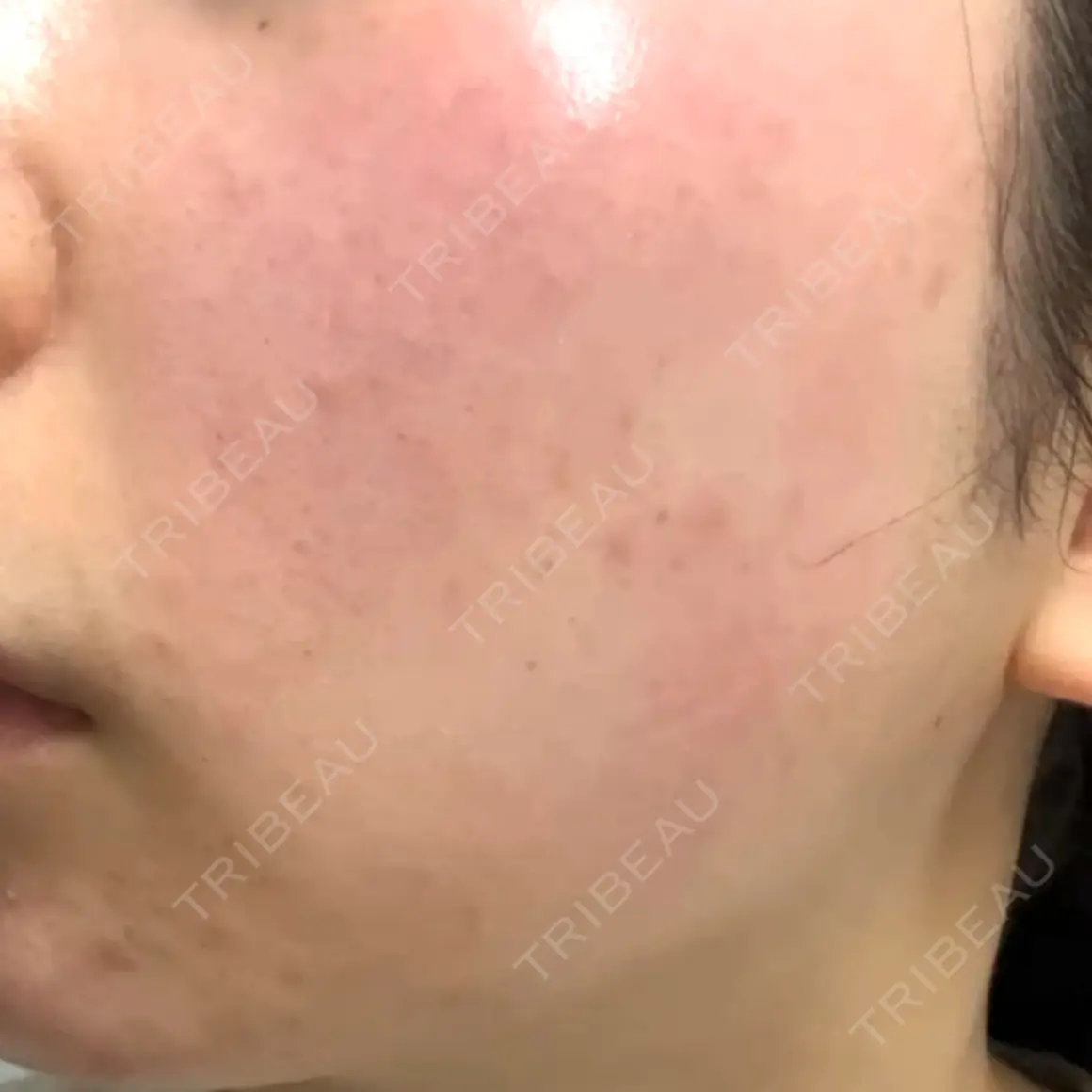 エレクトロポレーション Kinshicho Beauty Clinic （錦糸町ビューティークリニック） DAY 0