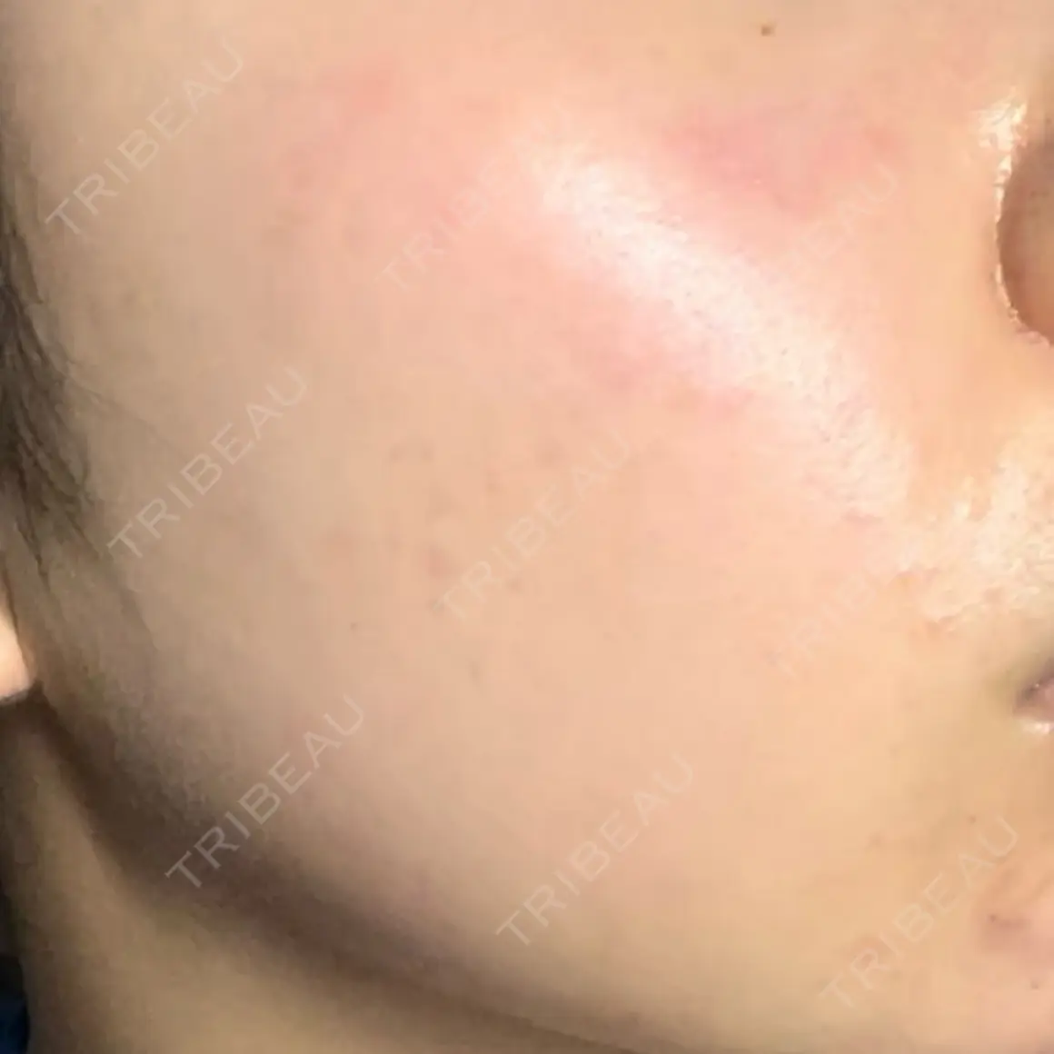 エレクトロポレーション Kinshicho Beauty Clinic （錦糸町ビューティークリニック） AFTER