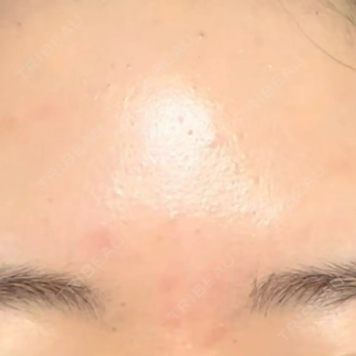 エレクトロポレーション Kinshicho Beauty Clinic （錦糸町ビューティークリニック） AFTER