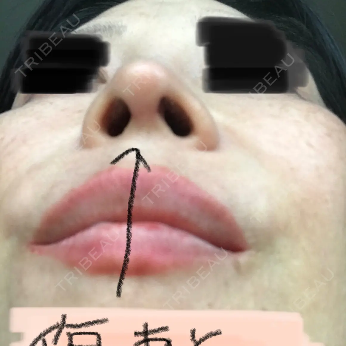 鼻尖形成（切開） / 鼻中隔延長（切開） / 軟骨移植 WOM CLINIC GINZA （ワム クリニック ギンザ） AFTER