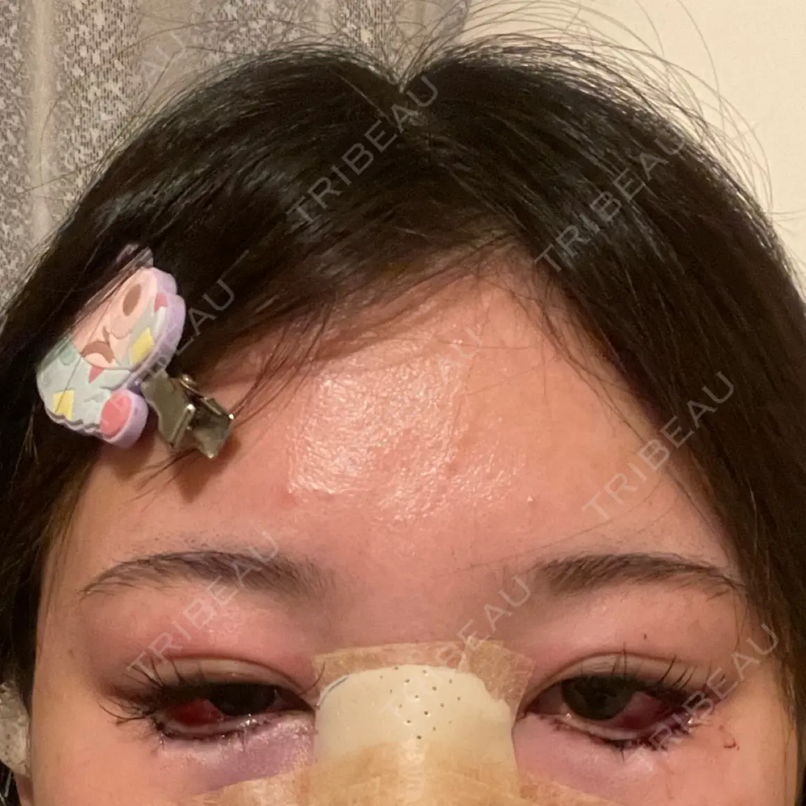 隆鼻術 / 鼻尖形成（切開） / 鼻中隔延長（切開） / 小鼻縮小（切開） / 目尻切開 / タレ目形成・グラマラスライン（切開） / 軟骨移植 / 目尻靭帯移動 エターナル美容クリニック DAY 0