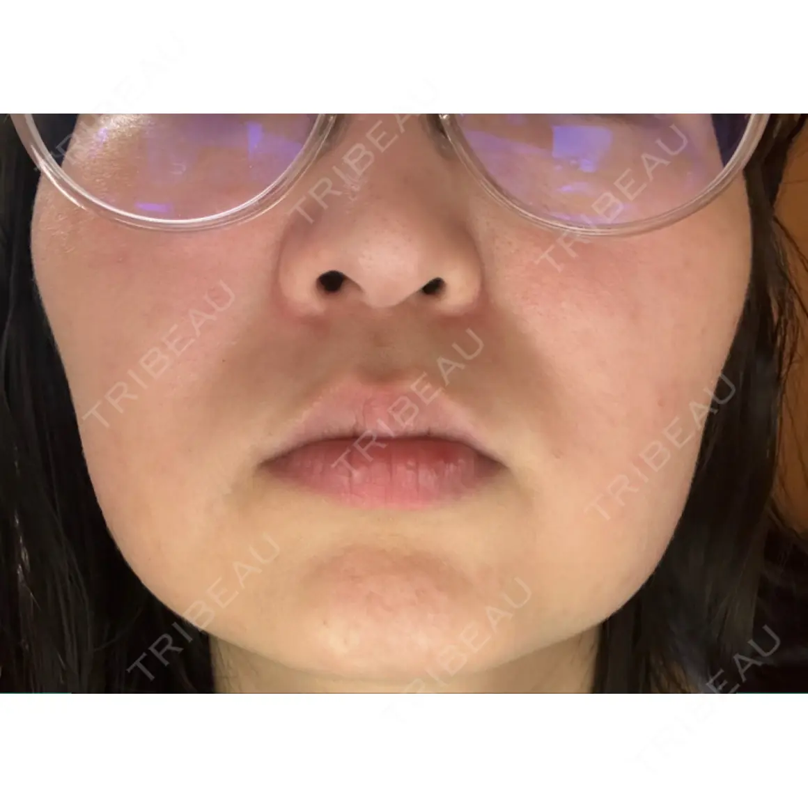 ボトックス（エラ・小顔） 共立美容外科 梅田院 AFTER