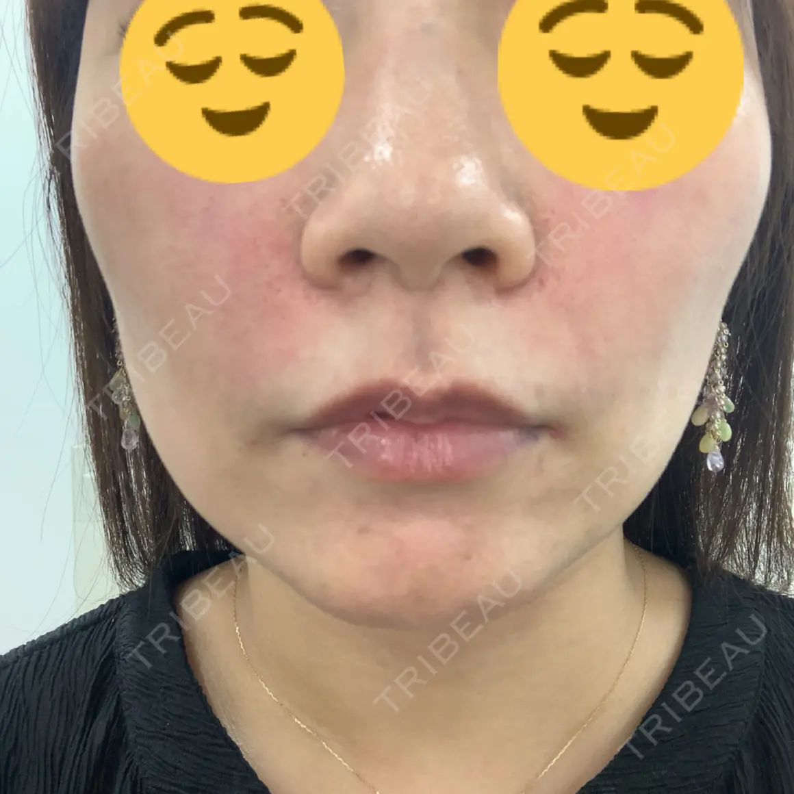 ヒアルロン酸注入（頬） 渋谷美容外科クリニック 渋谷院 DAY 0