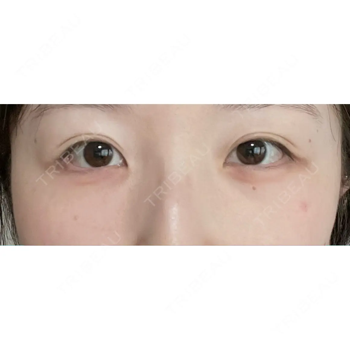 クマ治療 / ピコレーザートーニング（美白・肝斑） Days Beauty Clinic AFTER