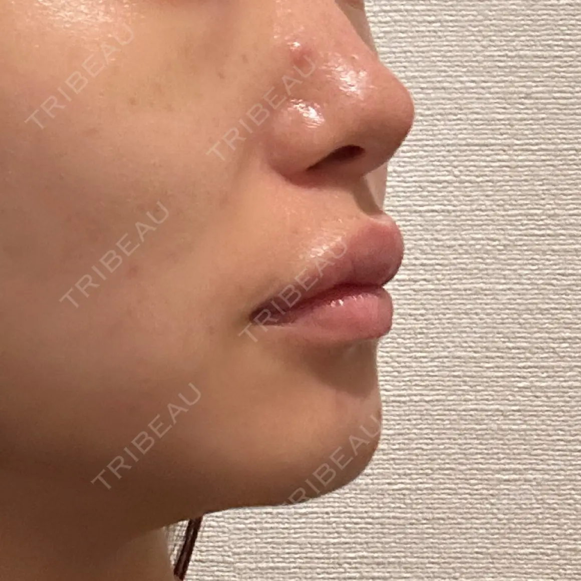 ヒアルロン酸注入（唇） / ボトックス（口角） ルラ美容クリニック 千葉院 AFTER