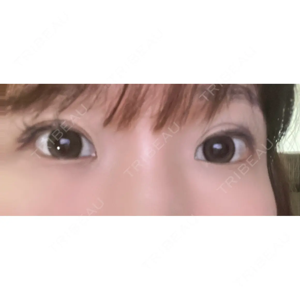 二重埋没 美容外科川崎クリニック 大阪梅田院 DAY 7