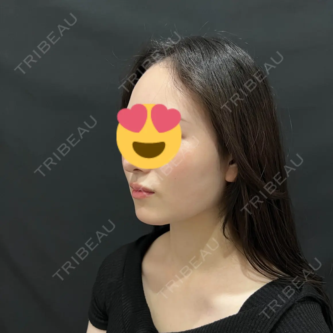 糸リフト / 脂肪吸引（顔） ブルームクリニック（BLOOM CLINIC） AFTER