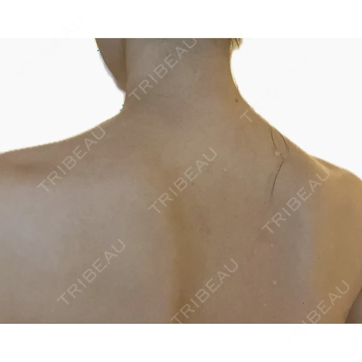 ボトックス（肩） 共立美容外科 浜松院 AFTER