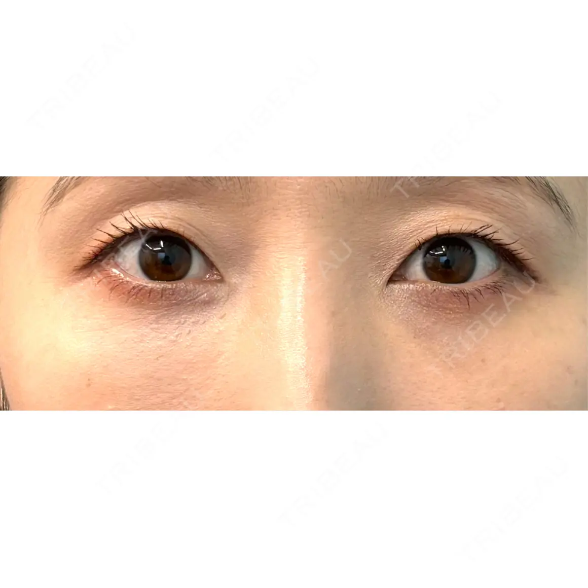 クマ治療 / 脂肪注入（目の下） 湘南美容クリニック 千葉センシティ院 AFTER