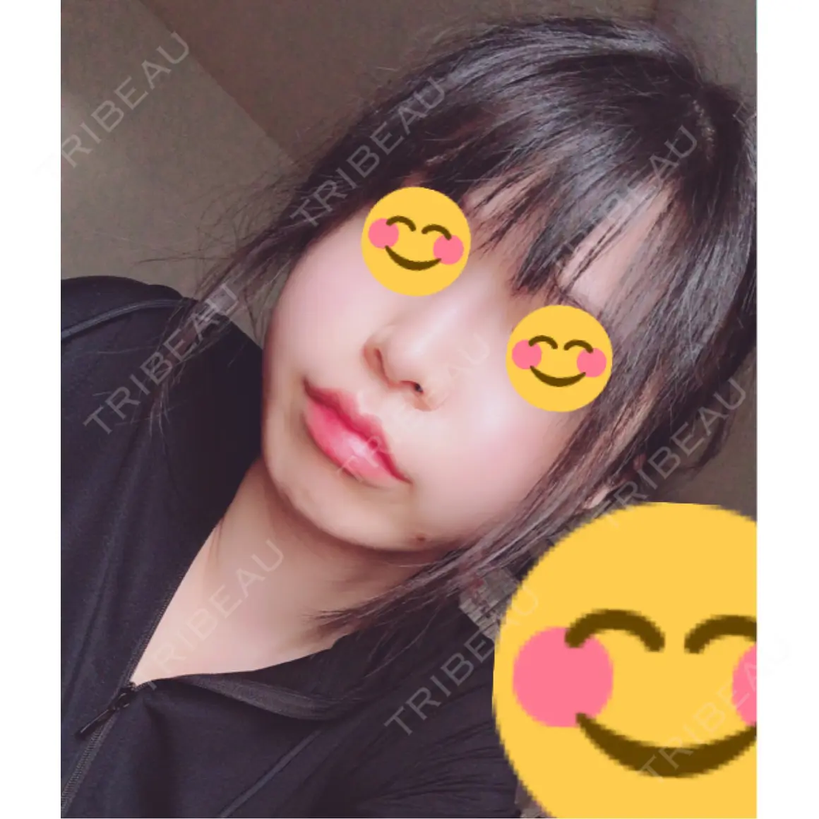 脂肪注入（肌） EMMO FACE CLINIC 大宮院 DAY 0