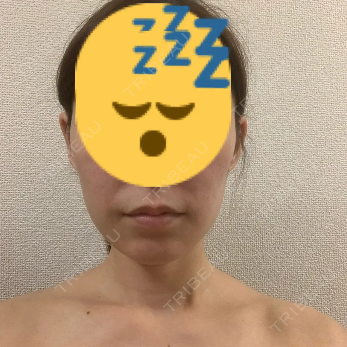 ボトックス（エラ・小顔） / ボトックス（肩） / ヒアルロン酸注入（鼻翼基部） ルラ美容クリニック 神戸院 AFTER