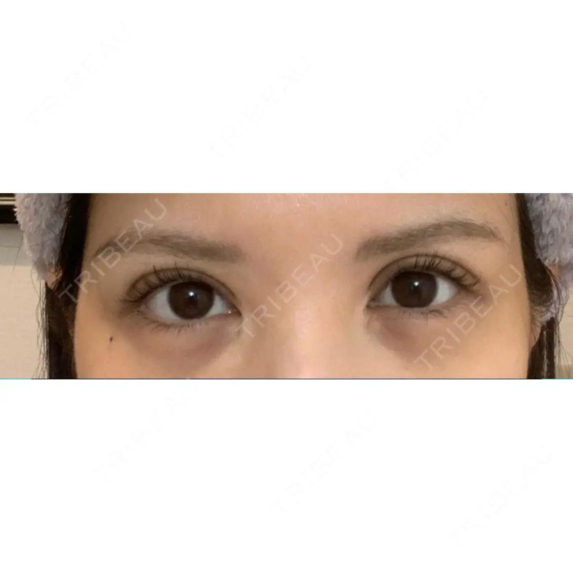 二重切開 / 目頭切開 / 眼瞼下垂（切開） / 上まぶたの脂肪取り エターナル美容クリニック AFTER