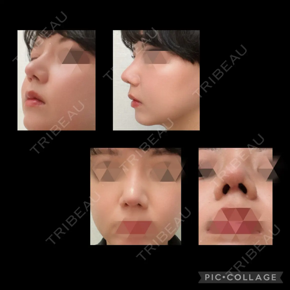 隆鼻術 / 鼻尖形成（切開） / 鼻中隔延長（切開） / 骨切幅寄せ / ワシ鼻修正・ハンプ切除 LUHO（ルホ）美容外科 DAY 31